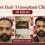 Best hair transplant clinic in delhi