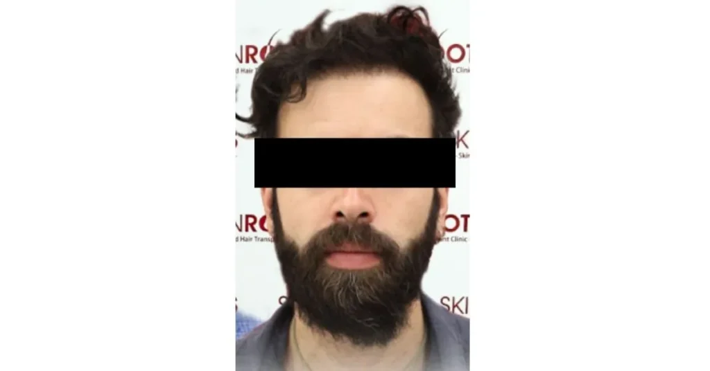 Best hair transplant clinic in india