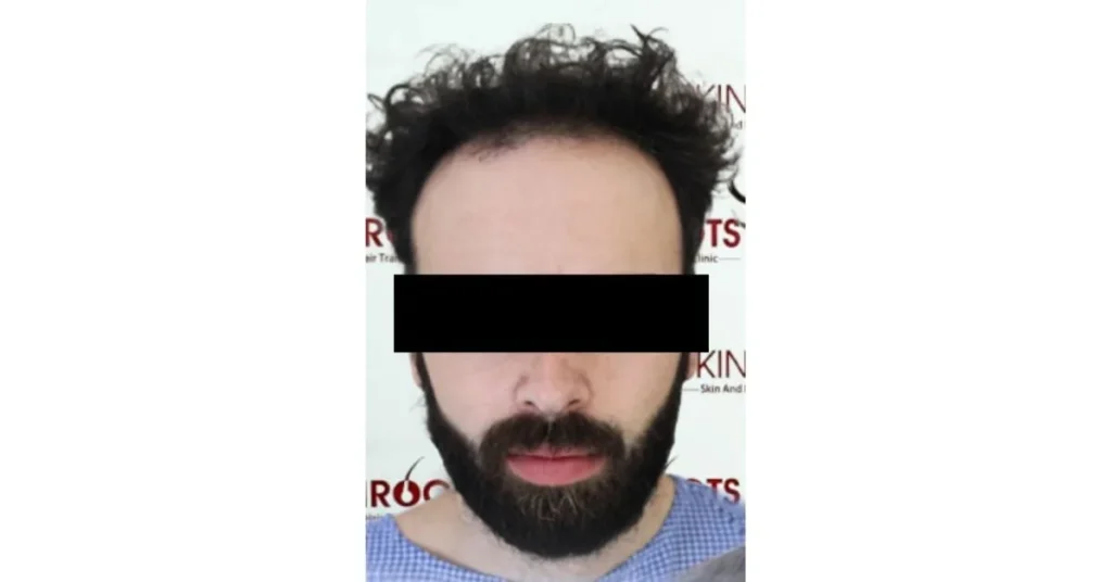 Best hair transplant clinic in india