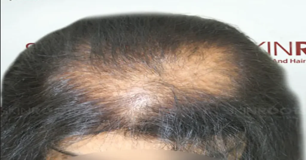 hair transplant in delhi