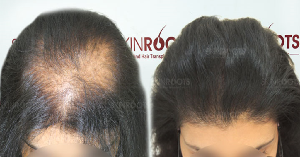 Best Hair Transplant Clinic in Delhi