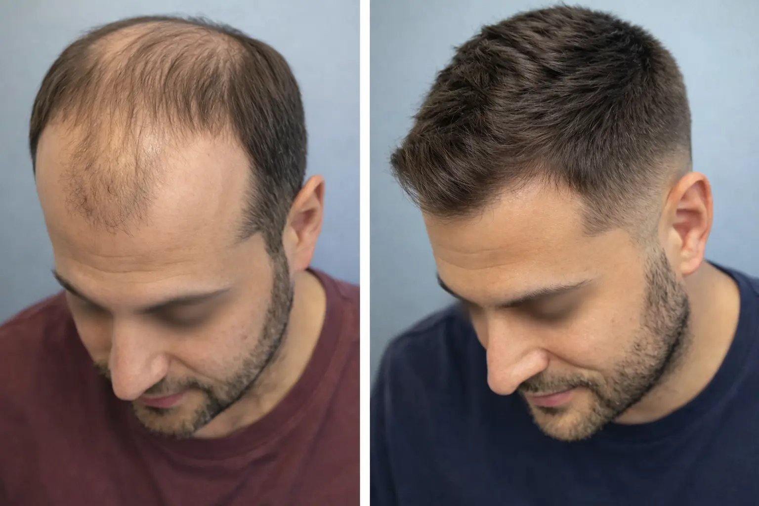 Hair transplant in delhi